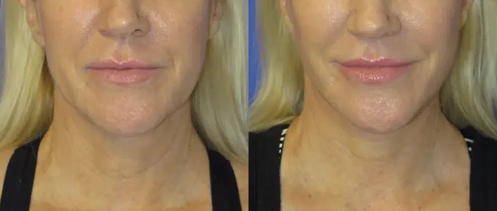 faceology lift neck Lift before and after photo by faceology md in newport beach ca