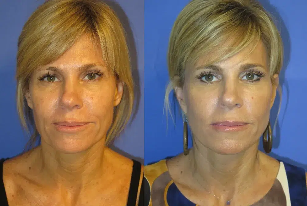 faceology lift neck Lift before and after photo by faceology md in newport beach ca