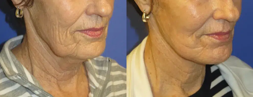 faceology lift neck Lift before and after photo by faceology md in newport beach ca