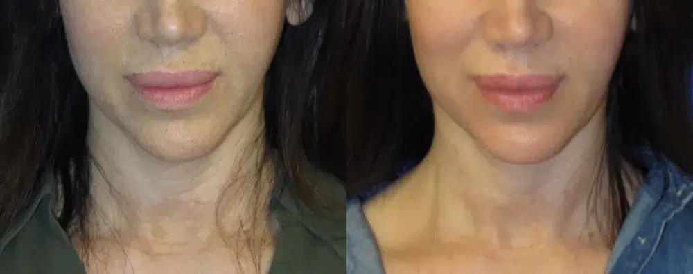 faceology lift neck Lift before and after photo by faceology md in newport beach ca