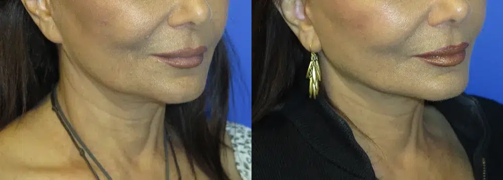 faceology lift neck Lift before and after photo by faceology md in newport beach ca