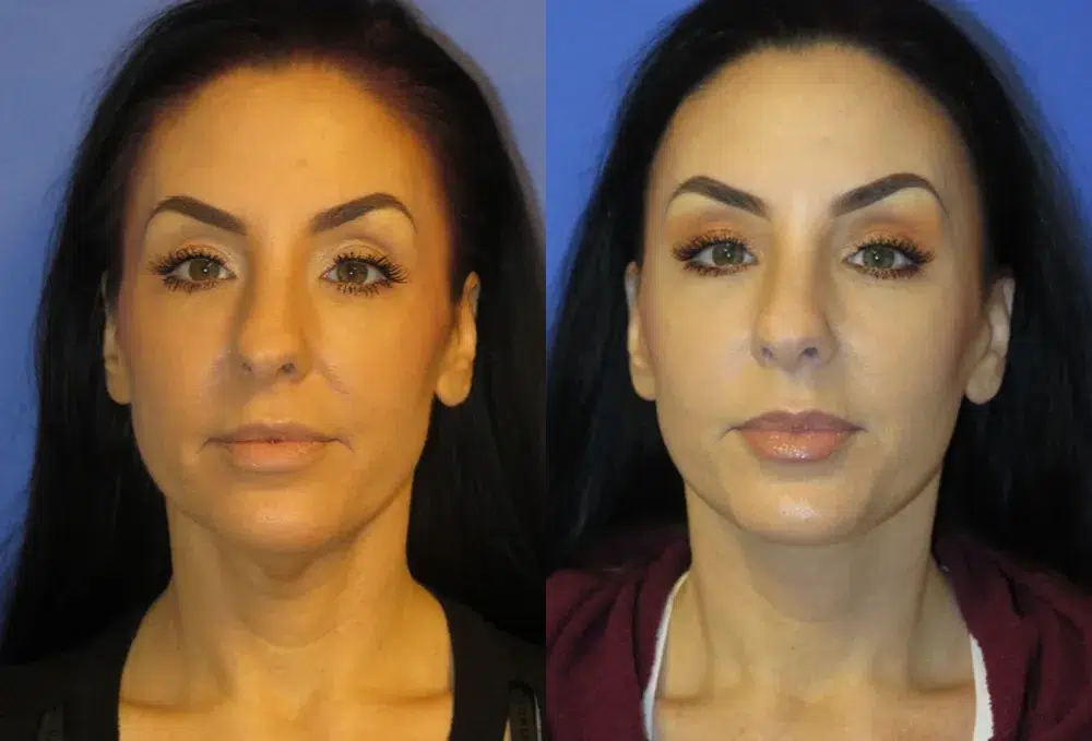 faceology lift neck Lift before and after photo by faceology md in newport beach ca