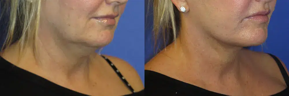 faceology lift neck Lift before and after photo by faceology md in newport beach ca