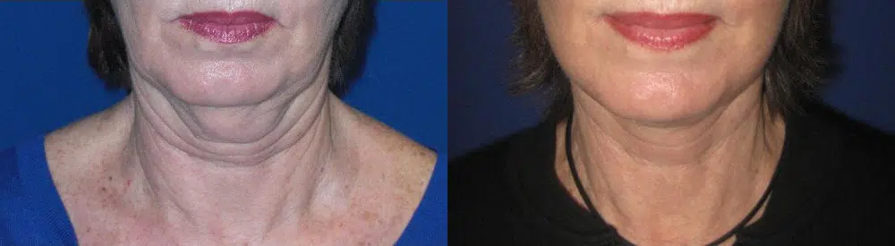 faceology lift neck Lift before and after photo by faceology md in newport beach ca