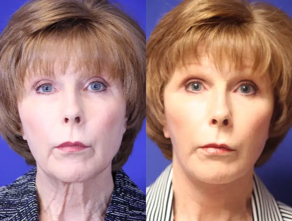 faceology lift neck Lift before and after photo by faceology md in newport beach ca