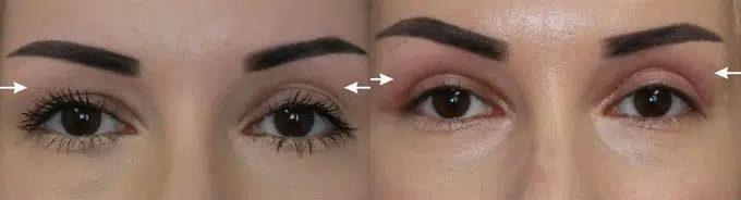 eyelid lift before and after photo by faceology md in newport beach ca