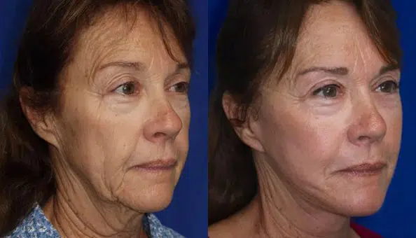 eyelid lift before and after photo by faceology md in newport beach ca