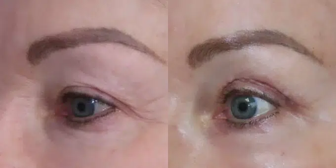 eyelid lift before and after photo by faceology md in newport beach ca