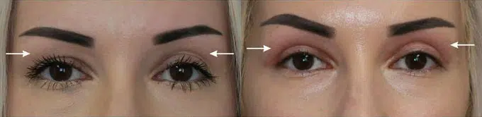 eyelid lift before and after photo by faceology md in newport beach ca