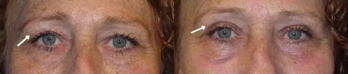 eyelid lift before and after photo by faceology md in newport beach ca