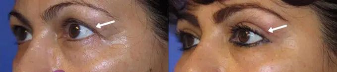 eyelid lift before and after photo by faceology md in newport beach ca