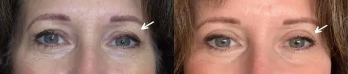 eyelid lift before and after photo by faceology md in newport beach ca