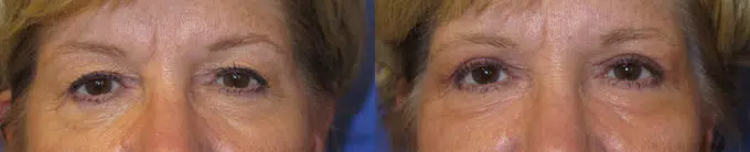 eyelid lift before and after photo by faceology md in newport beach ca