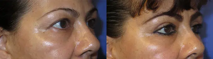 eyelid lift before and after photo by faceology md in newport beach ca