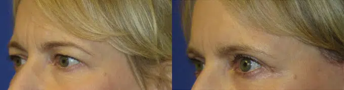eyelid lift before and after photo by faceology md in newport beach ca