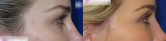 eyelid lift before and after photo by faceology md in newport beach ca