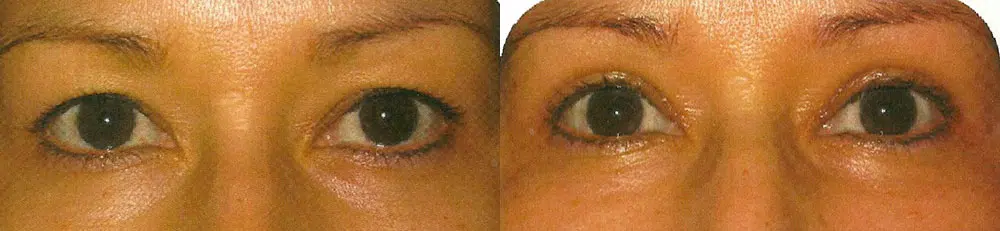 eyelid lift before and after photo by faceology md in newport beach ca