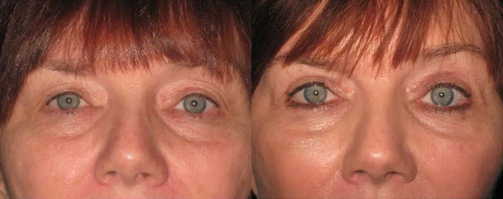 eyelid lift before and after photo by faceology md in newport beach ca
