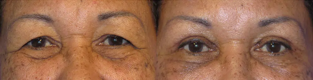 eyelid lift before and after photo by faceology md in newport beach ca