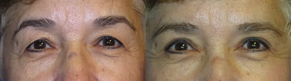 eyelid lift before and after photo by faceology md in newport beach ca
