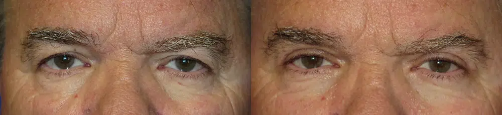 eyelid lift before and after photo by faceology md in newport beach ca
