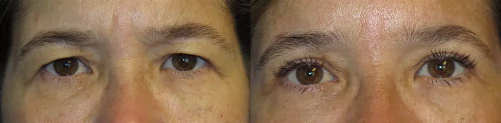 eyelid lift before and after photo by faceology md in newport beach ca