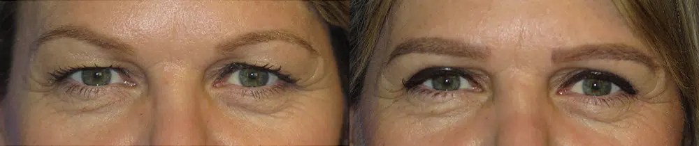 eyelid lift before and after photo by faceology md in newport beach ca