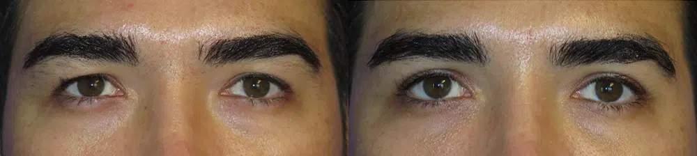eyelid lift before and after photo by faceology md in newport beach ca