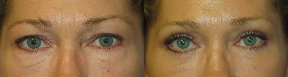 eyelid lift before and after photo by faceology md in newport beach ca