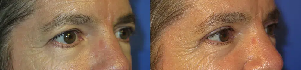 eyelid lift before and after photo by faceology md in newport beach ca eyelid lift before and after photo by faceology md in newport beach ca