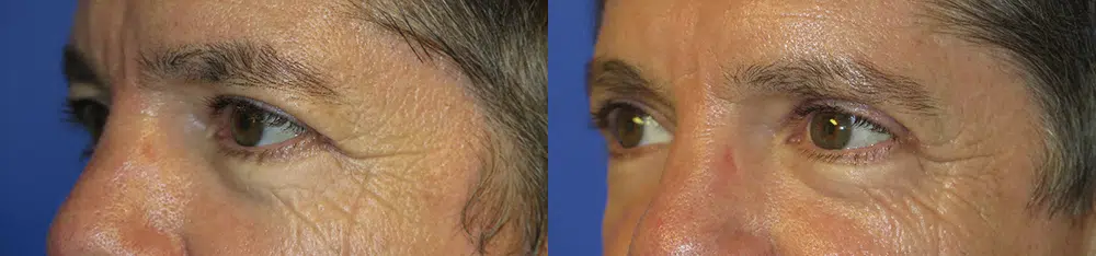 eyelid lift before and after photo by faceology md in newport beach ca eyelid lift before and after photo by faceology md in newport beach ca