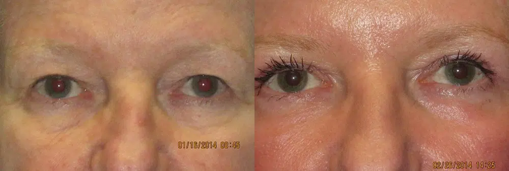 eyelid lift before and after photo by faceology md in newport beach ca