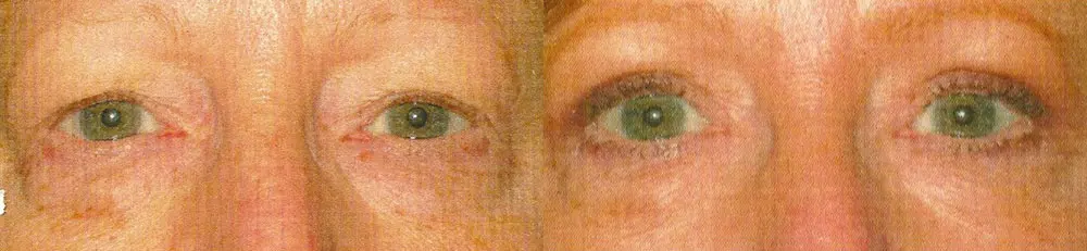 eyelid lift before and after photo by faceology md in newport beach ca