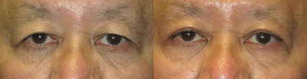 eyelid lift before and after photo by faceology md in newport beach ca