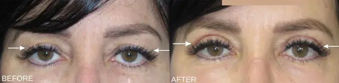 eyelid lift before and after photo by faceology md in newport beach ca