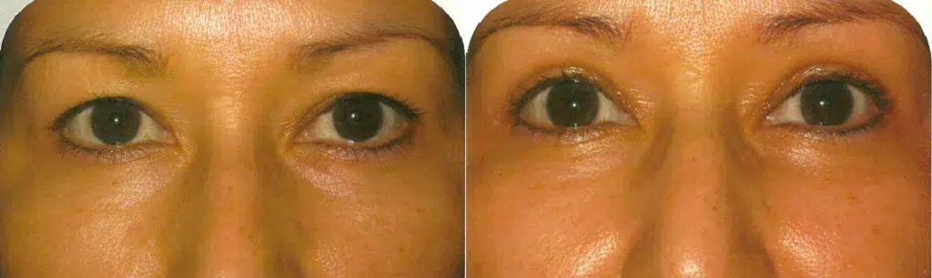 eyelid lift before and after photo by faceology md in newport beach ca