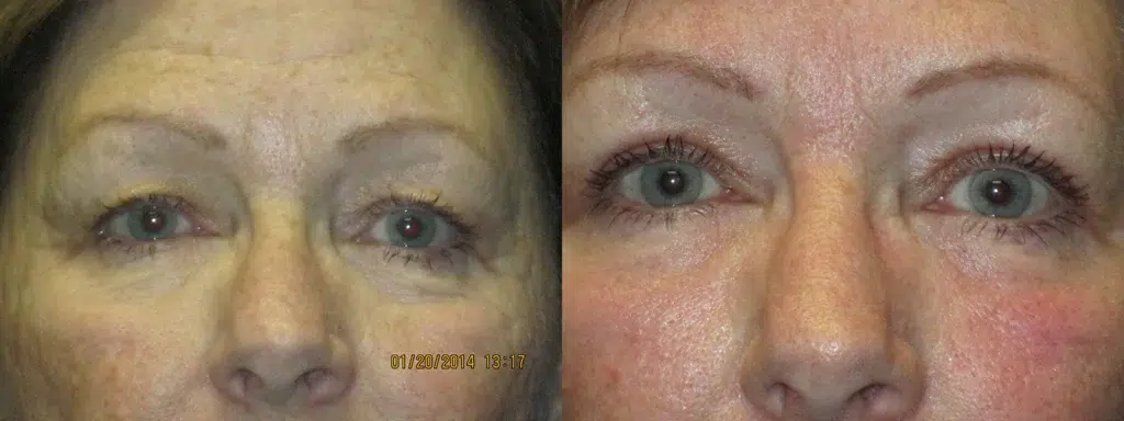 eyelid lift before and after photo by faceology md in newport beach ca