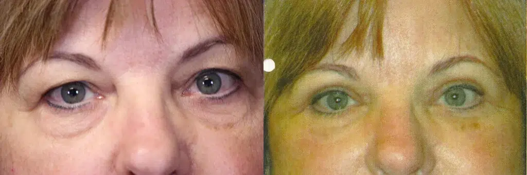 eyelid lift before and after photo by faceology md in newport beach ca