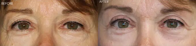eyelid lift before and after photo by faceology md in newport beach ca
