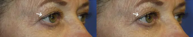 eyelid lift before and after photo by faceology md in newport beach ca