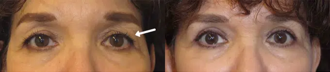 eyelid lift before and after photo by faceology md in newport beach ca
