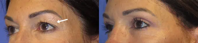 eyelid lift before and after photo by faceology md in newport beach ca