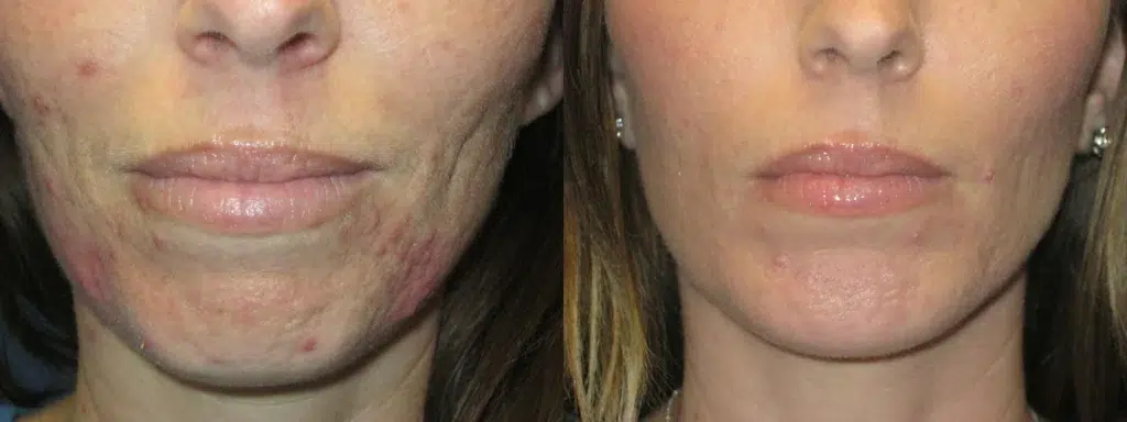 chin implant before and after photo by faceology md in newport beach ca