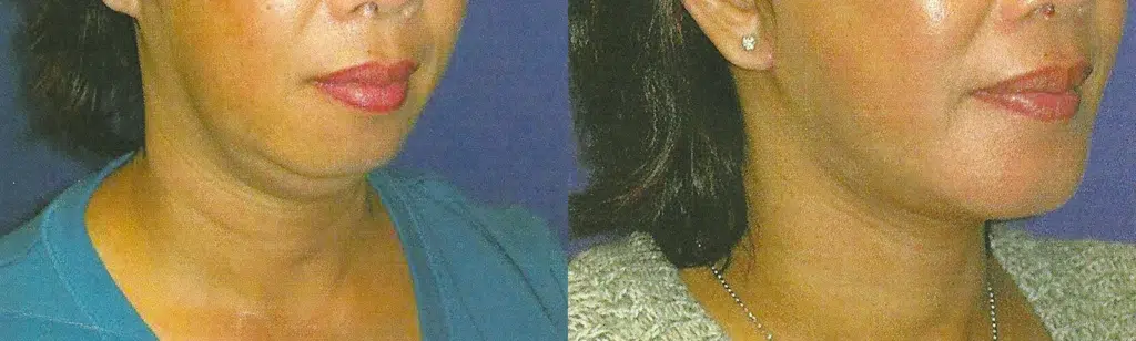 chin implant before and after photo by faceology md in newport beach ca