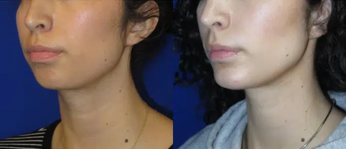 chin implant before and after photo by faceology md in newport beach ca