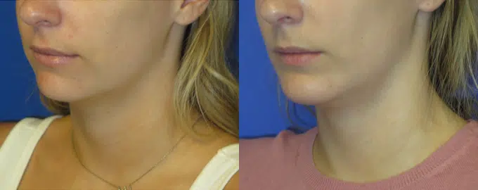 chin implant before and after photo by faceology md in newport beach ca