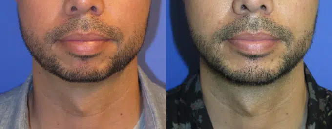 chin implant before and after photo by faceology md in newport beach ca