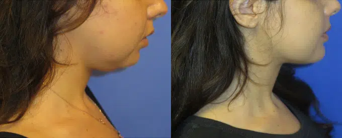 chin implant before and after photo by faceology md in newport beach ca