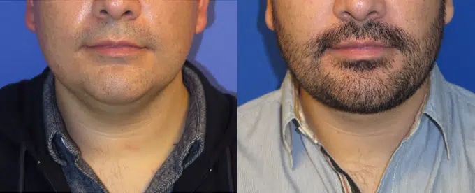 chin implant before and after photo by faceology md in newport beach ca