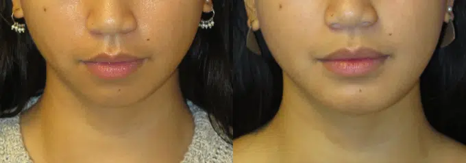 chin implant before and after photo by faceology md in newport beach ca